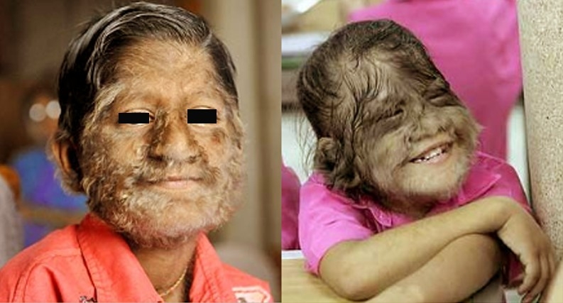 Hipertrihoza