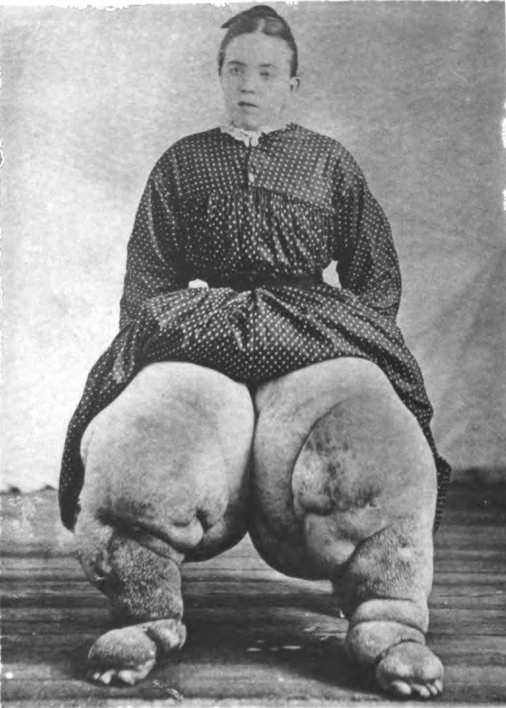 Elephantiasis