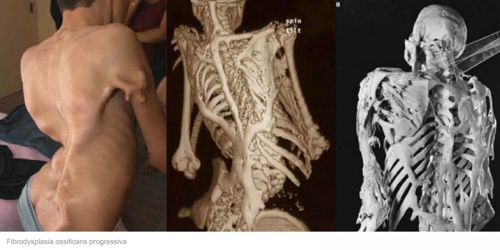 Fibrodysplasia ossificans progressiva